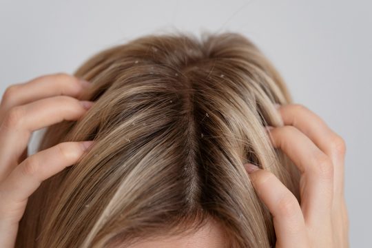 Woman with dandruff issues close up