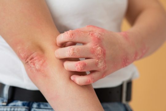 Hands of patient suffering from psoriasis