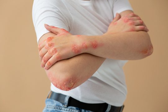 Hands of patient suffering from psoriasis