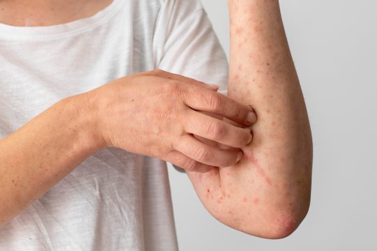 Skin allergy reaction on person's arm